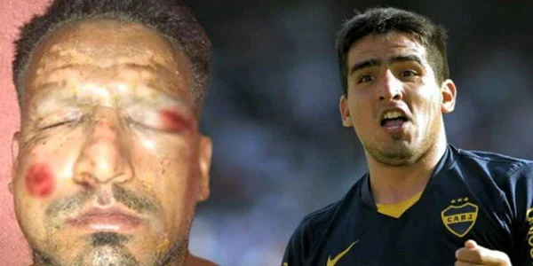 Sifətində fişəng partlayan məşhur futbolçu tanınmaz hala düşdü - FOTO 