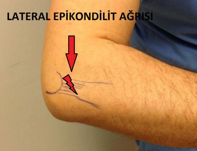 Peşəkar idmanın yaratdığı xroniki xəstəliklər: Lateral epikondilit - "Tennisçi dirsəyi" 