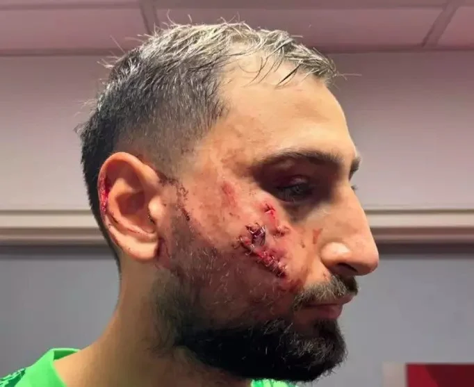 PSJ qələbə qazandı, Donnarumma meydanı qan içində tərk etdi - FOTO 