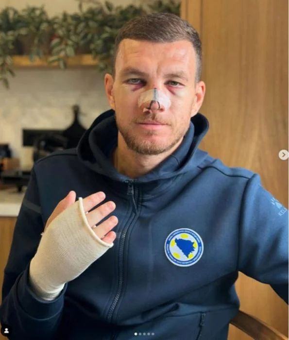 Edin Dzeko qorxunc vəziyyətə düşüb - FOTO 