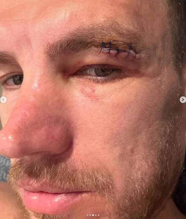 Edin Dzeko qorxunc vəziyyətə düşüb - FOTO 