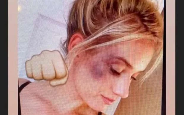 Məşhur xanım idmançının bu halı görənləri qorxutdu - FOTO 