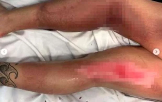 Soyuqda bədəni yanan qadın idmançı ayaqlarını itirdi - FOTOLAR 